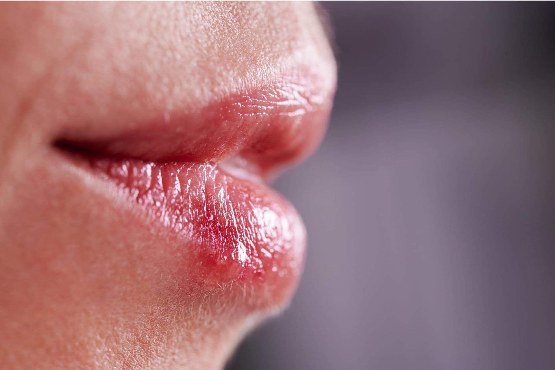 Genital herpes vs. pimple